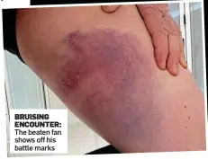  ??  ?? BRUISING ENCOUNTER: The beaten fan shows off his battle marks