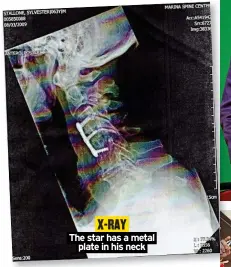  ?? ?? X-RAY
The star has a metal plate in his neck