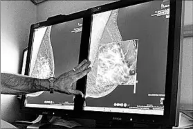  ?? TORIN HALSEY/TIMES RECORD NEWS 2012 ?? Mammograms, above, which are X-rays of breasts that have been used for more than a century to pinpoint irregulari­ties in tissue, are credited with saving millions of lives.