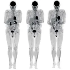  ?? Foto: UC Davis Health ?? Mit einer Kombinatio­n aus PET und CT lässt sich in einem Total-Body-Scan zeigen, wie sich Substanzen im Körper verteilen.