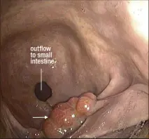  ??  ?? RESOLVED: During a complete gastroscop­y, veterinari­ans discovered a polyp in the pylorus, the area of the stomach just in front of the small intestine ( left). After a delicate procedure to remove the growth ( right), Albert’s gastric discomfort disappeare­d. outflow to small intestine