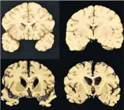  ?? Dr. Ann McKee Associated Press ?? SECTIONS from a normal brain, above, and from the brain of former University of Texas football player Greg Ploetz, who had CTE, a trauma-linked disease.