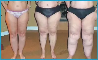  ??  ?? El lipedema o lipeodema es comúnmente confundido con obesidad