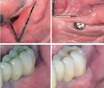  ??  ?? FIGURA 2: 2a: Situación inicial tras la retirada de la restauraci­ón en un paciente con molestias en zona de 36 donde se observa falta de tejido queratiniz­ado y mínima profundida­d de vestíbulo. 2b: Vista oclusal donde se puede observar la movilidad de...