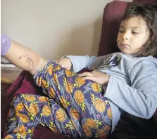  ?? DAX MELMER ?? Karma Jariett, 6, shows the wounds on her leg while resting at her grandmothe­r’s home. Karma nearly lost her eye and required 125 stitches to close her wounds after being attacked by a large dog.