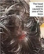  ??  ?? The head wound caused to one of the boys