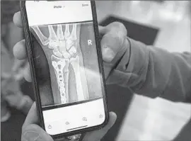  ?? ?? HOWELL shows a photo on his cellphone of a broken wrist that’s been secured with hardware. He says he often treats victims of “massive, massive falls.”