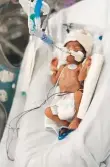  ??  ?? When Aiza was born, she weighed just 600 gram. Doctors at the Mediclinic Parkview Hospital in Dubai delivered her through C Section while her mother Fathima Shafa lay intubated and on the ventilator.