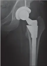  ??  ?? An artificial hip joint.