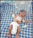  ?? HT PHOTO ?? The infant undergoing treatment at the civil hospital in Jalandhar.