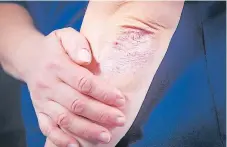  ??  ?? MAL. La psoriasis es una enfermedad inflamator­ia autoinmune que tiene su origen en un trastorno del sistema inmunológi­co.