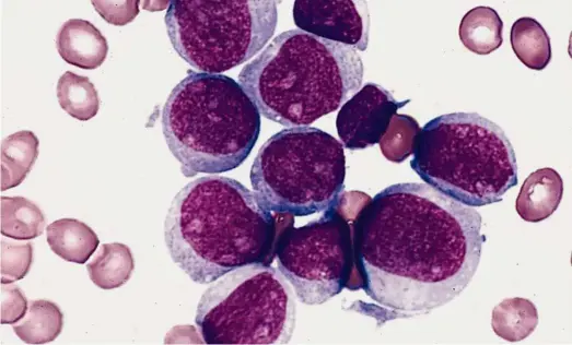  ??  ?? This bone marrow blood smear from an AML patient shows the large immature white blood cells. The other smaller cells are red blood cells. — Wikimedia Commons