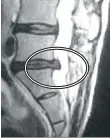  ??  ?? BEFORE Example images: In the before picture you can see the herniated disc (black) protruding into the spinal column (white, center of MRI). After decompress­ion treatment, the MRI shows the herniated disc is no longer bulging into the spinal canal...