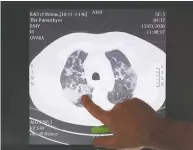  ?? YVES HERMAN / REUTERS ?? Belgian Dr. Ignace Demeyer at Onze Lieve Vrouw Hospital points to a scanner image of the lungs
of a patient suffering from COVID-19.