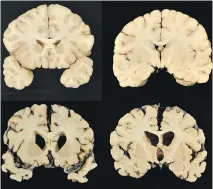  ?? DR. ANN McKEE/THE ASSOCIATED PRESS ?? A recent study by Scottish neuropatho­logist Dr. William Stewart found “no significan­t associatio­ns between number of concussion­s and performanc­e on cognitive tests.”