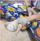  ??  ?? OUCH: Above and left, San Min Hteik, 14, shows his injured hand during an interview at his home in the Myaung Dagar industrial zone in Hmawbi Township in Yangon.