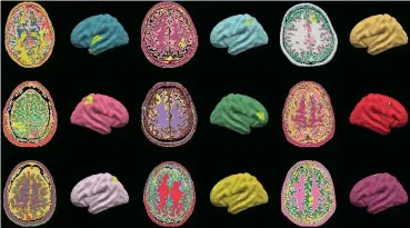  ?? ?? Brain abnormalit­ies identified by the MELD AI algorithm (highlighte­d in lime green) on MRI scans of children and adults with epilepsy from around the world.