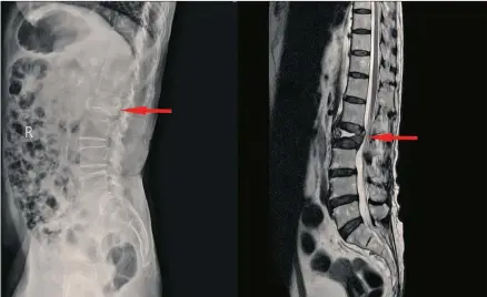  ?? ?? MRI scan of a bulging disc in the lumbar spine (lower back).