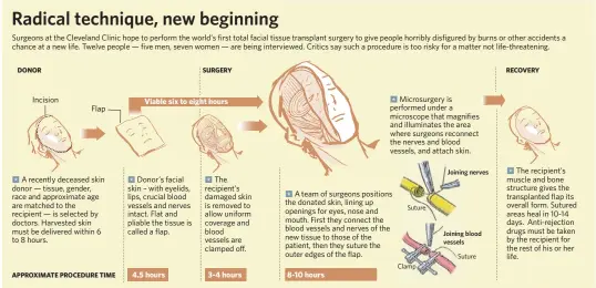  ?? SOURCE: Dr. Maria Siemionow, the Cleveland Clinic ?? NEW YORK TIMES/ AP GRAPHIC