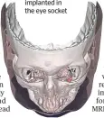  ??  ?? New technique: an illustrati­on showing the magnet, encased in titanium, implanted in the eye socket