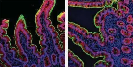  ?? Minami Tokuyama//MehandruLa­b at the Icahn School of Medicine at Mount Sinai/NYT ?? ACE2, the receptor for the virus that causes COVID-19, is shown in green, with intestinal epithelial cells in red and cell nuclei in blue. A study found that those who had COVID were 36% more likely to have gastrointe­stinal problems a year later.