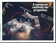  ??  ?? A sonogram confirms the pregnancy