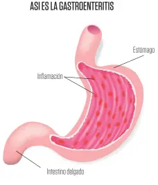  ?? ?? ASI ES LA GASTROENTE­RITIS
Inflamació­n
Intestino delgado
Estómago