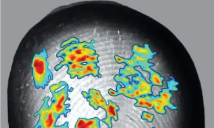  ??  ?? Receptive fields of sensory neurons in the hand, mapped on to a fingertip. Photograph: Jarocka et al, JNeurosci 2021