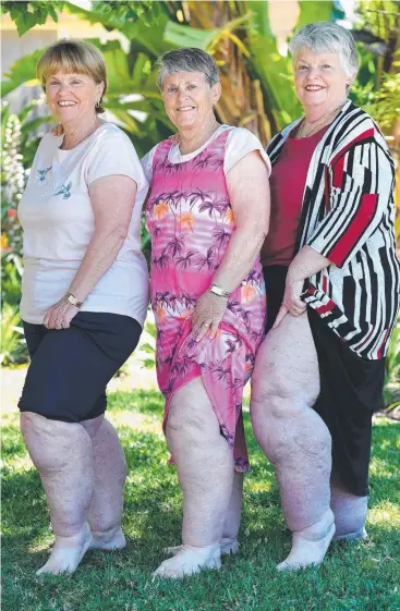  ?? Picture: TRICIA WATKINSON ?? RESEARCH: Sisters Diane Pastro, Helen Hughes and Sue Bastick suffer from lipoedema and are bravely baring their legs to raise awareness of the condition.