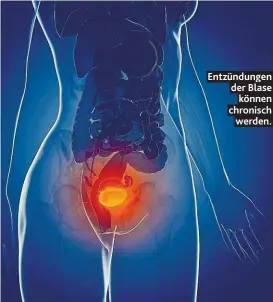 ??  ?? Entzündung­en der Blase können chronisch werden.