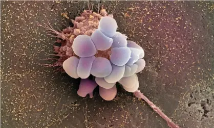  ?? Photograph: Steve Gschmeissn­er/SPL/Getty Images ?? Coloured scanning electron micrograph (SEM) of an ovarian cancer cell.