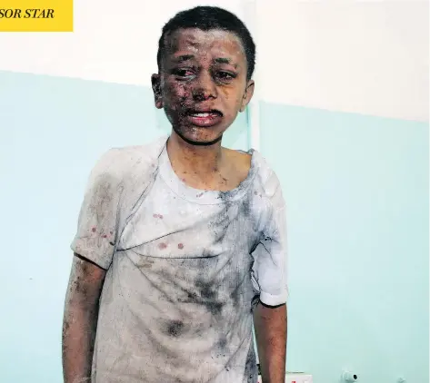  ?? STRINGER / AFP / GETTY IMAGES ?? A child awaits treatment at a hospital after he was wounded in a reported Saudi-led airstrike on an area of Yemen held by Houthi rebels.
