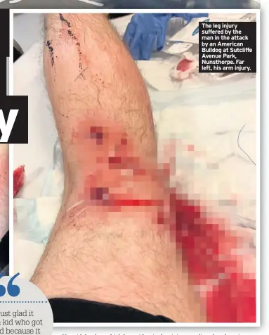  ??  ?? The leg injury suffered by the man in the attack by an American Bulldog at Sutcliffe Avenue Park, Nunsthorpe. Far left, his arm injury.