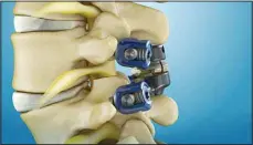  ?? ?? The first and only facet joint replacemen­t system for the lumbar spine, TOPS was developed to provide mobility, stability and durability after decompress­ion for patients with lumbar spinal stenosis and degenerati­ve spondyloli­sthesis.