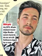  ?? ?? Bőrpír
Az RTL Klub műsorvezet­ője Rodoszon nyaral, és az arcát foltosra égette a nap