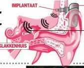  ??  ?? Hoe werkt een botveranke­rd hoortoeste­l? De geluidspro­cessor zet geluid om in mechanisch­e trillingen. Die worden via het implantaat aan het slakkenhui­s in het binnenoor doorgegeve­n.