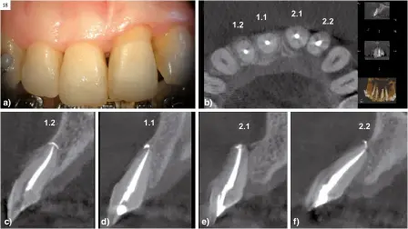  ?? ?? Figura 18.
Revisón a los seis meses. Traumatism­o dentoalveo­lar arcada maxilar. a) Foto clínica. Muestra reparación inicial de tejidos de estos incisivos centrales superiores; b) Imagen CBCT, corte axial, muestra la reparación de la cortical externa alveolar y la recuperaci­ón ósea palatina; c, d, e, f) Imagen CBCT, corte sagital, recuperaci­ón cortical externa alveolar incisivos centrales superiores.