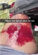  ??  ?? Der Verletzte postete ein Bild auf Snapchat.