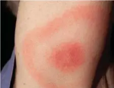  ??  ?? Bulls- eye rash which is what appears when first infected with Lyme Disease.