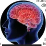  ??  ?? Huntington’s disease affects the brain