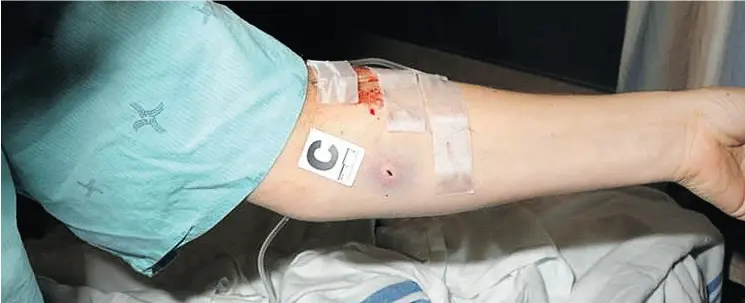  ?? PHOTOS: RCMP HANDOUT / THE CANADIAN PRESS ?? One of Const. Darlene Goguen’s wounds. Doctors were able to remove all the metal from her arm, she testified Tuesday, and told her one bullet missed her spine by a “millimetre.”