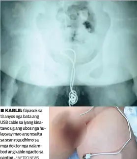  ?? / METRO NEWS ?? ■ KABLE: Gipasok sa 13 anyos nga bata ang USB cable sa iyang kinatawo ug ang ubos nga hulagway mao ang resulta sa scan nga gihimo sa mga doktor nga nalambod ang kable ngadto sa pantog .