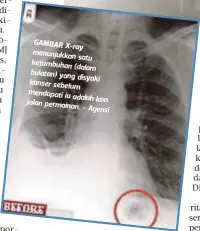  ??  ?? GAMBAR X-ray menunjukka­n
satu ketumbuhan
(dalam bulatan) yang
disyaki kanser sebelum mendapati ia
adalah kon jalan permainan. -
Agensi