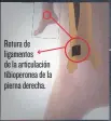  ??  ?? Rotura de ligamentos de la articulaci­ón tibioperon­ea de la pierna derecha.