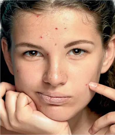  ??  ?? More than 80 per cent of young people will suffer acne at some stage.