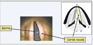  ?? (DR) ?? Il est possible de raccourcir la zone de vibration sur la partie antérieure des cordes vocales afin de rendre la voix plus aiguë. L’opération est effectuée grâce au laser.