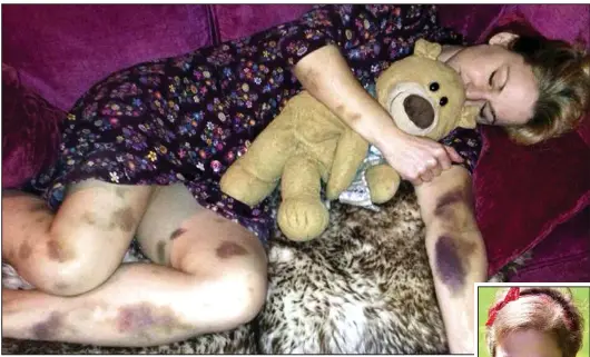  ??  ?? Alarming: Thea Wilson, 37, woke up to find these vivid purple and yellow marks all over her arms and legs