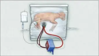  ?? CHILDREN’S HOSPITAL OF PHILADELPH­IA VIA AP ?? In this drawing provided by the Children’s Hospital of Philadelph­ia, an illustrati­on of a fluid-filled incubation system that mimics a mother’s womb, in hopes of one day improving survival of extremely premature babies. In animal testing, fetal lambs...