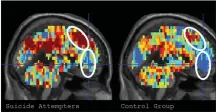  ??  ?? Brain scans can ‘read’ people’s suicidal thoughts.