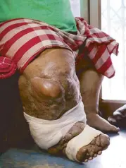  ??  ?? Symptoms of lymphatic filariasis include chronic swelling of the legs, arms and male genitals. People with LF are also less able to resist common skin infections, resulting in a cruel cycle of fevers and painful swellings.